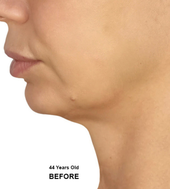 V Facelift Device